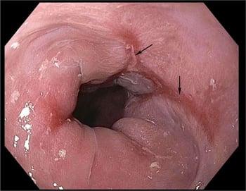 Esophagitis Caused by Gastroesophageal Reflux